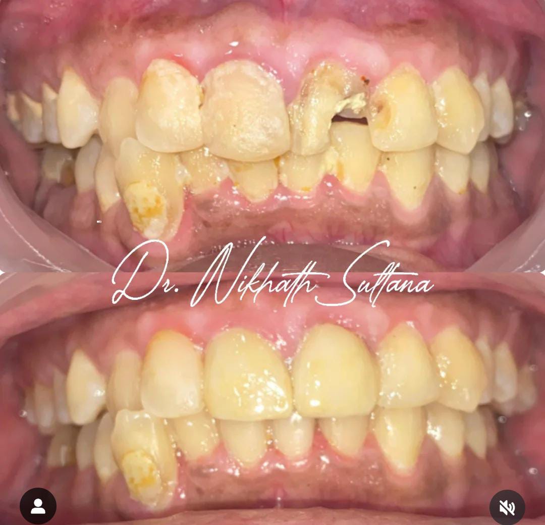 Veneers Case 1